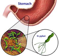 h.pylori-stomach