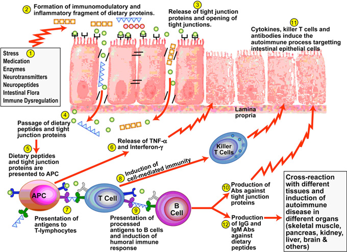 pathogenesis-leaky-gut-autoimmune-connection