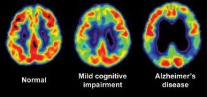 PET-scan-brain-normal-MCI-Alzheimer's