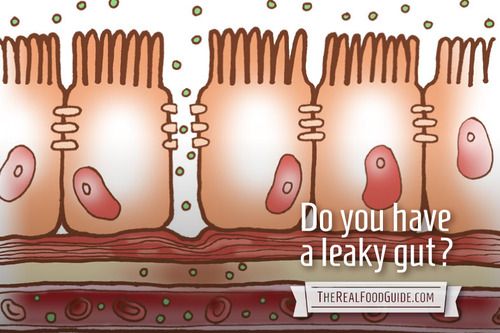 do-you-have-leaky-gut