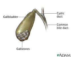 gallstones-gall-bladder-biliary-ducts